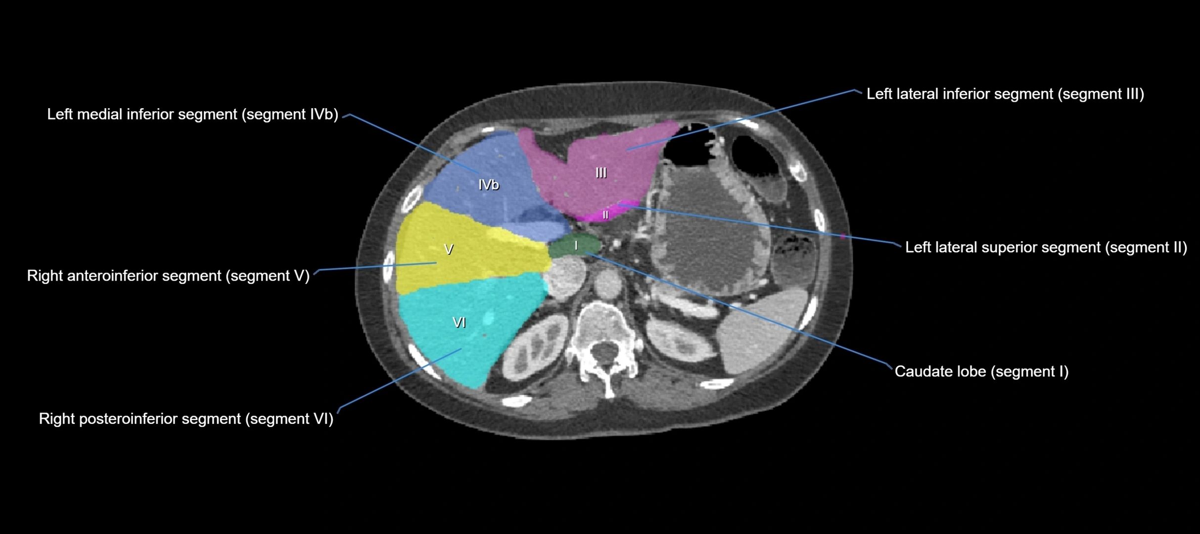 CT liver segments axial cross sectional anatomy labelled image-00046.webp